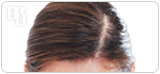 Male pattern baldness is a symptom of high testosterone levels.