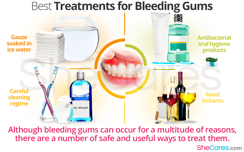 Best Treatments for Bleeding Gums