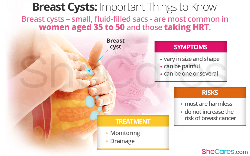 Breast cysts are most common in women aged 35 to 50 and those taking HRT.