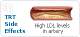 Increased LDL (“bad”) cholesterol is a side effect of testosterone replacement therapy.