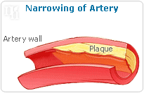 HRT has been linked to coronary artery spasms