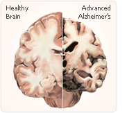 hrt alzheimer