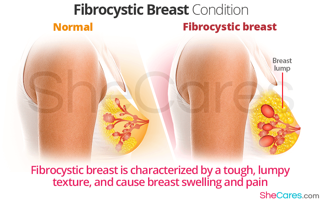 Fibrocystic breast condition