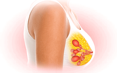 All About Breast Swelling and Pain