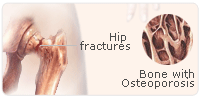 natural hormones fractures