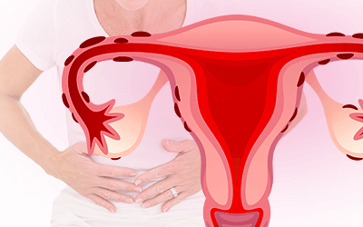 Endometriosis After Menopause