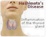 Using Natural Hormones for Thyroid Problems