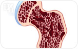 Can HRT Prevent Osteoporosis?