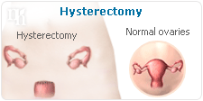 Hysterectomy