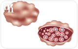 Recognizing Polycystic Ovary Syndrome
