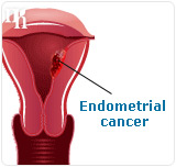 Endometrial cancer