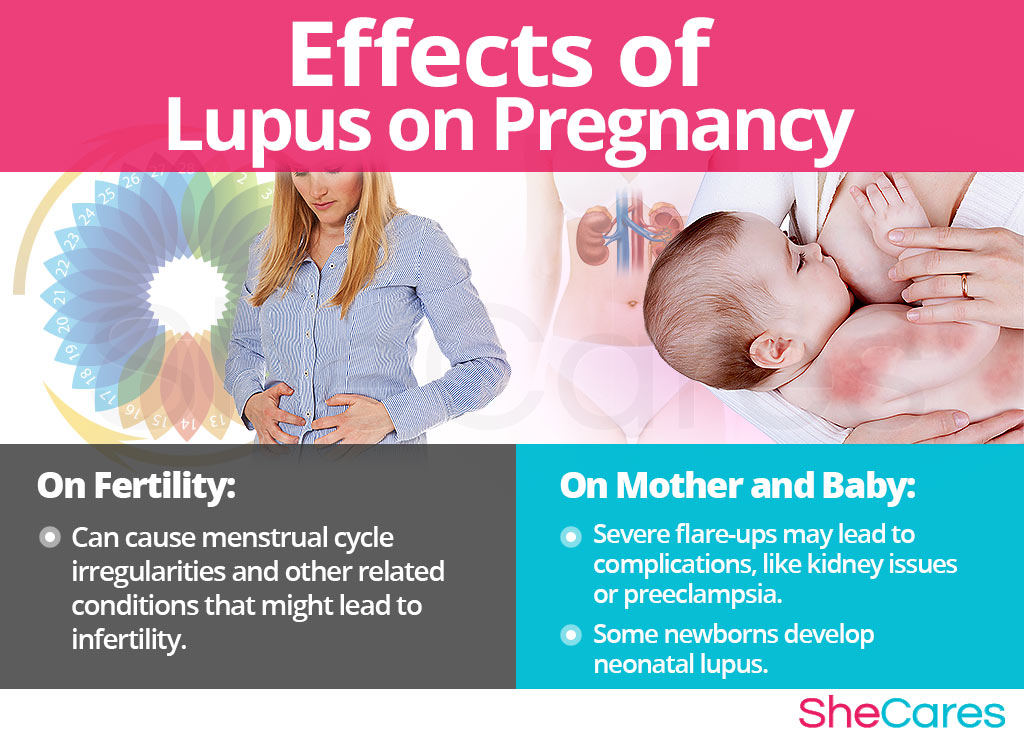 Effects of Lupus on Conception