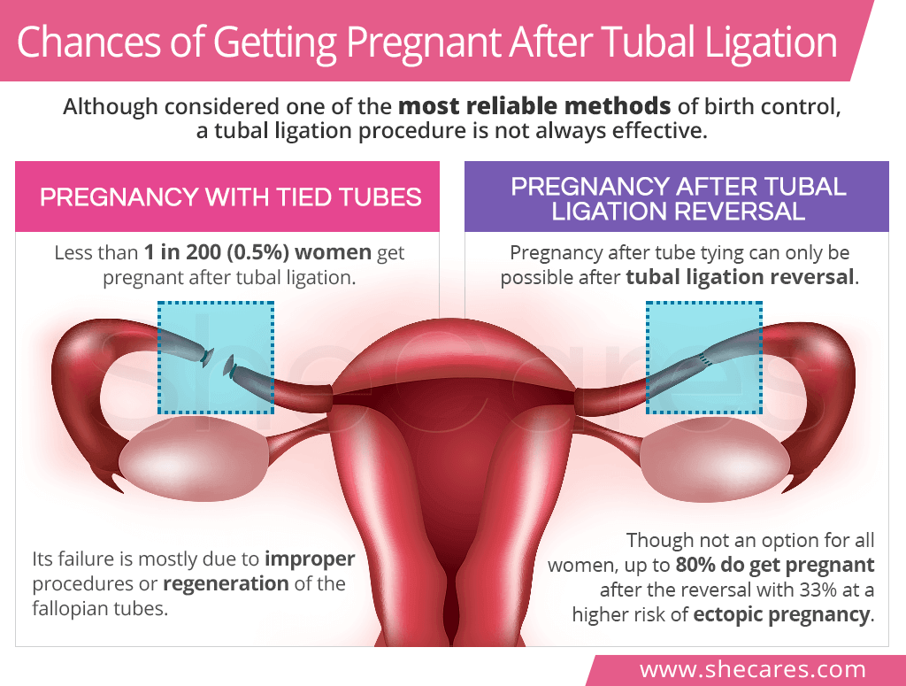 Chances of getting pregnant after tubal ligation