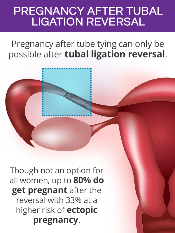 Pregnancy after tubal ligation reversal