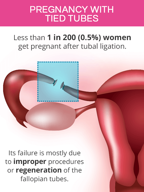 Pregnancy after tubal ligation