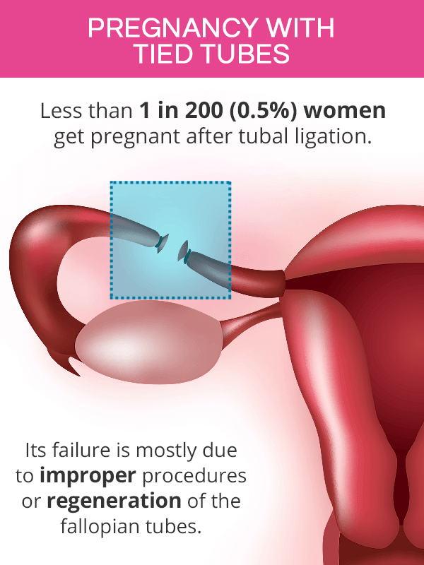 Will I Get Pregnant After Tubal Surgery?