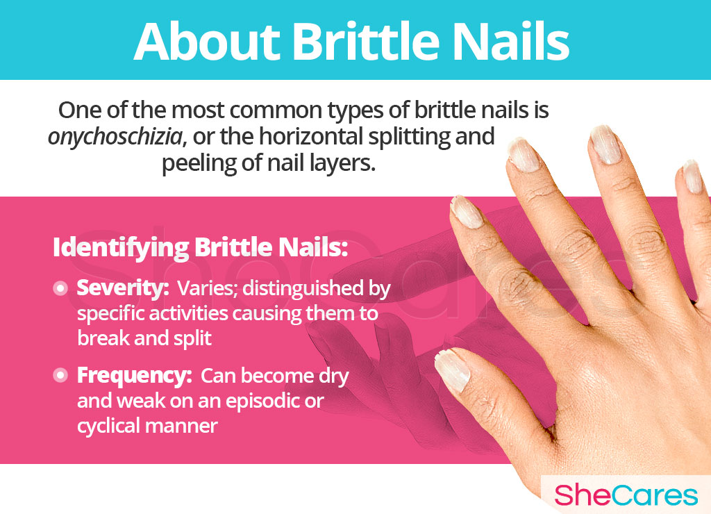 About Brittle Nails
