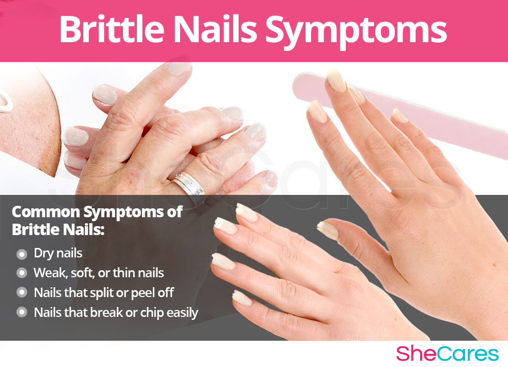 Brittle Nails - Signs and Symptoms