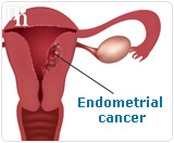 Endometrial cancer