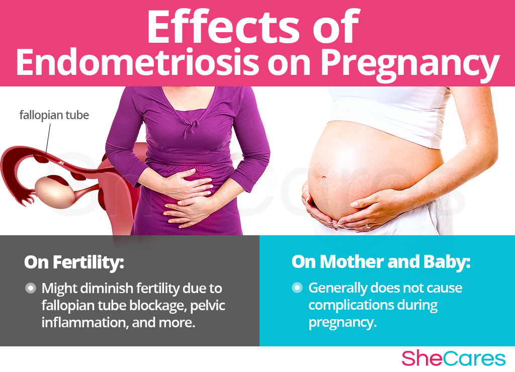 Effects of Endometriosis on Pregnancy