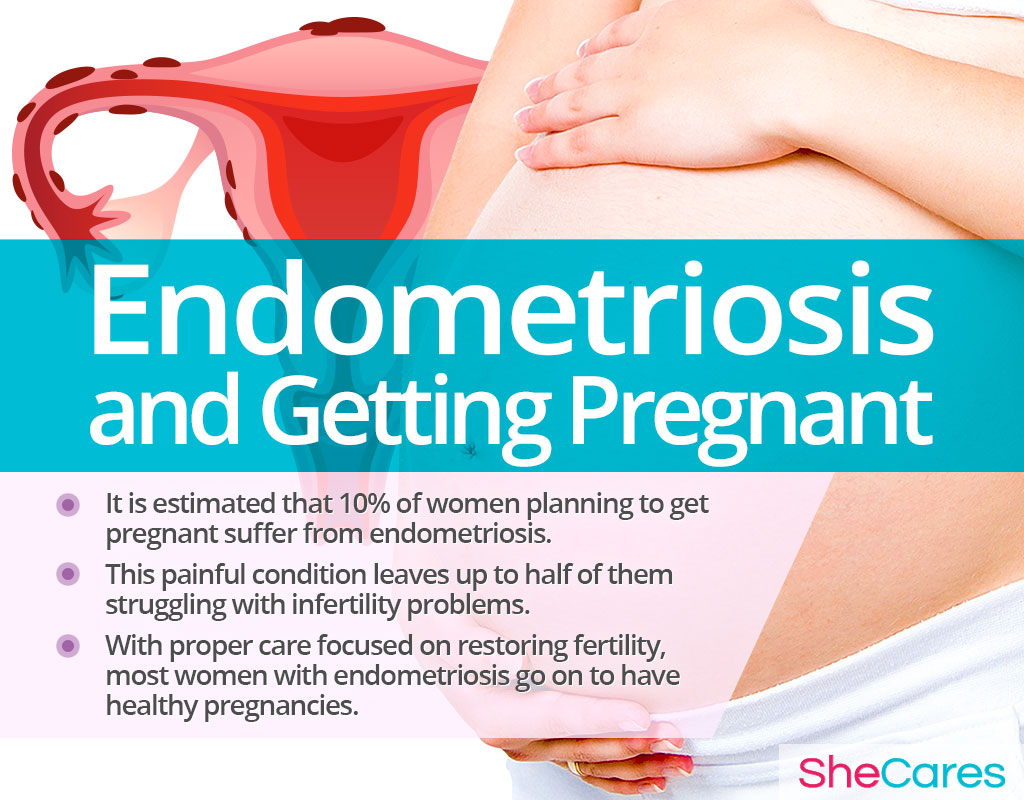 Endometriosis and Getting Pregnant