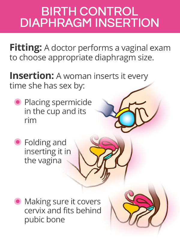 Birth control diaphragm insertion