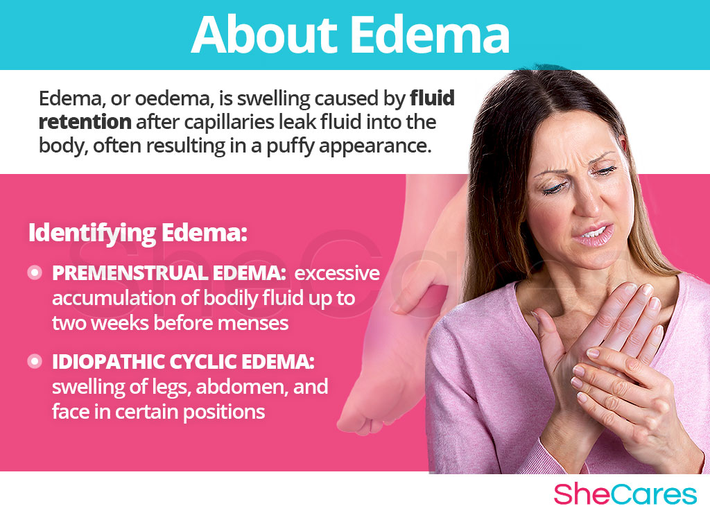 About Edema