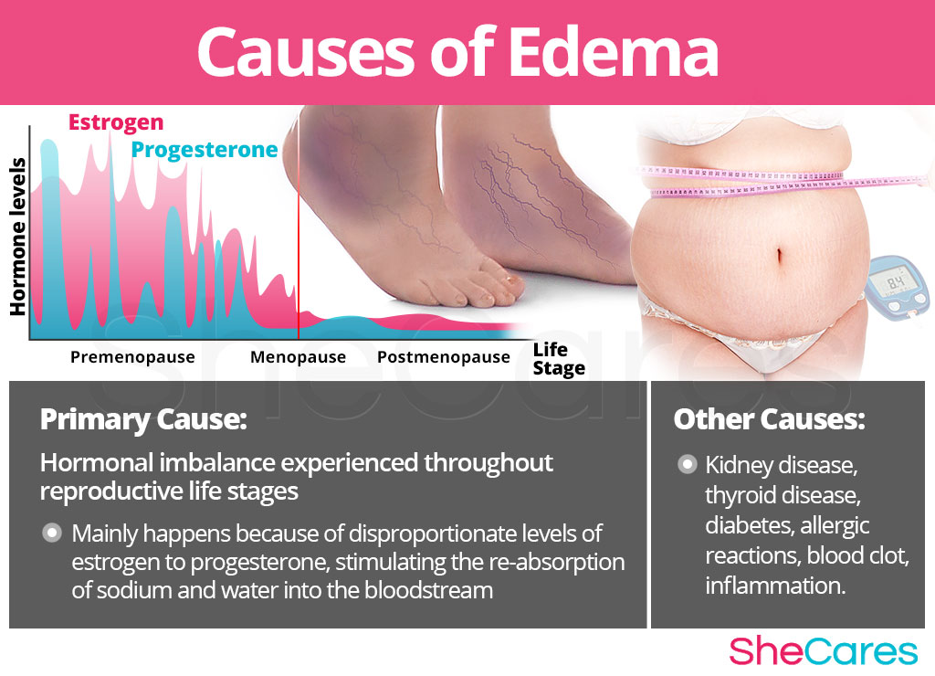 Causes of Edema