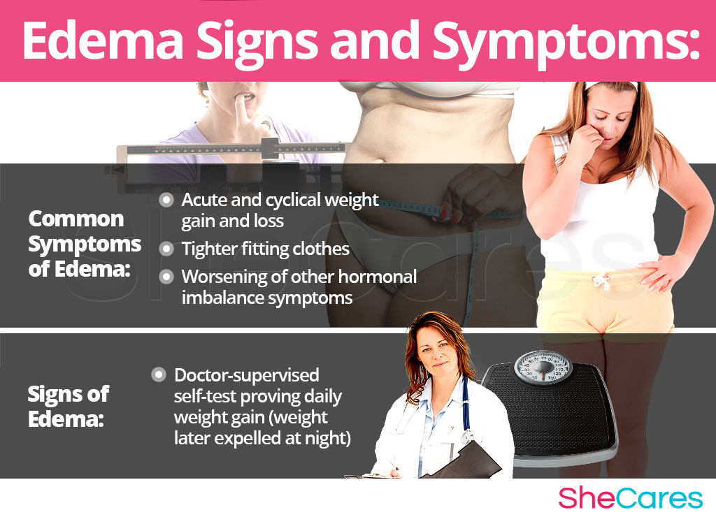 Edema - Signs and Symptoms