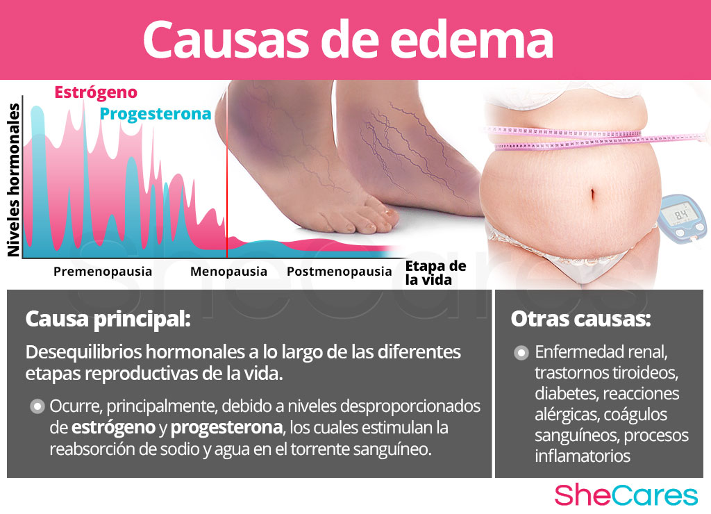 Causas de edema