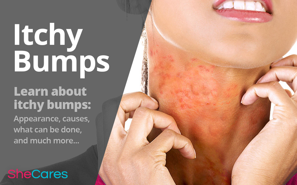 All about Itchy Bumps