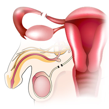 Female and male sterilization