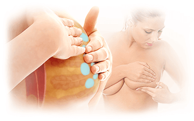 Breast Cysts: Important Things to Know