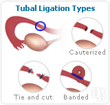 Tubal ligation types