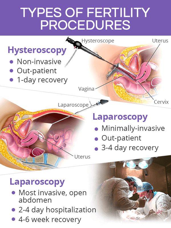 Types of fertility procedures