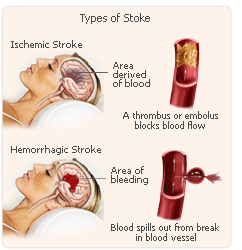 hrt embolus