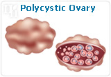 Polycystic ovary