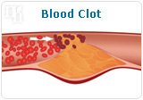 Blood clot