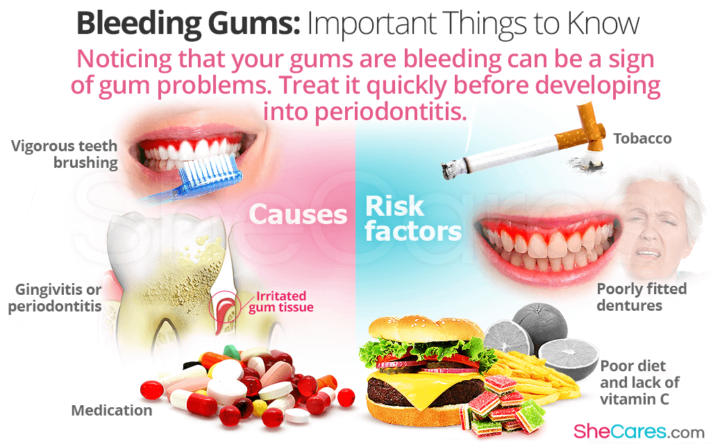 Noticing that your gums are bleeding can be a sign of gum problems.