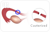 Post Tubal Ligation Syndrome: Causes and Symptoms
