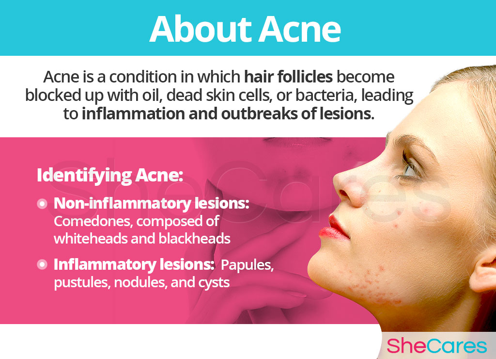 About Acne