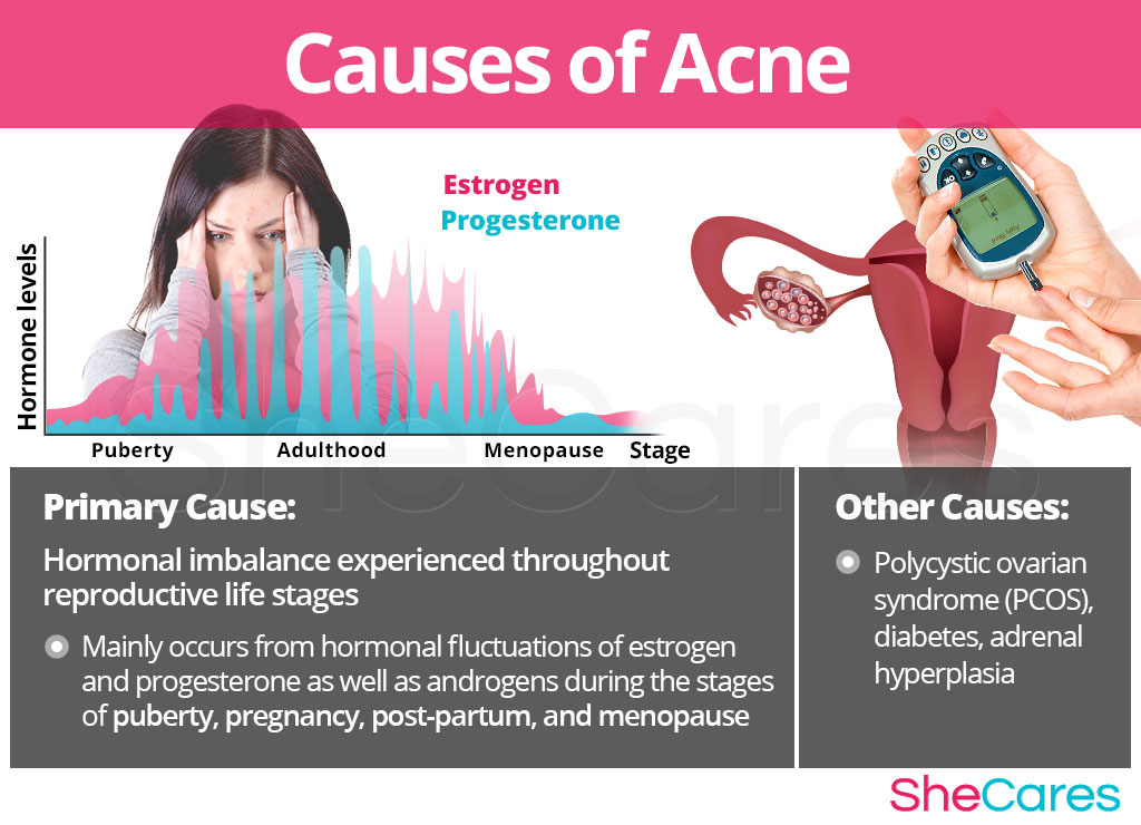 Causes of Acne