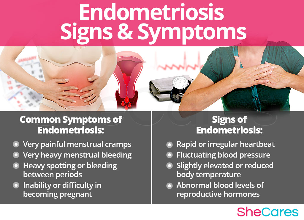 Endometriosis - Signs and Symptoms