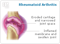 Rheumatoid Arthritis