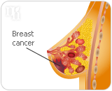 HRT has a higher risk of developing breast cancer and other diseases