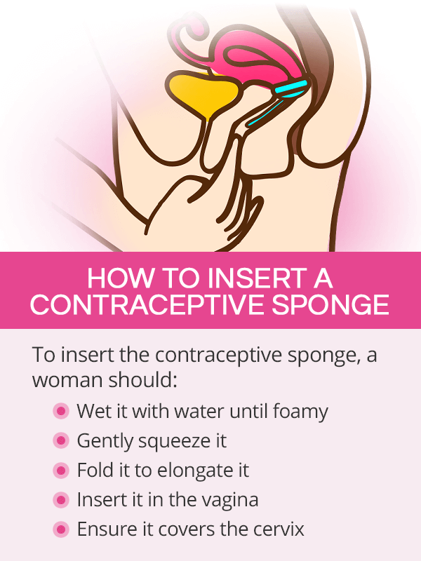 How to insert a contraceptive sponge