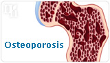 Osteoporosis