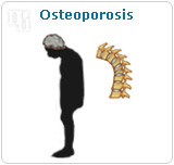 Osteoporosis