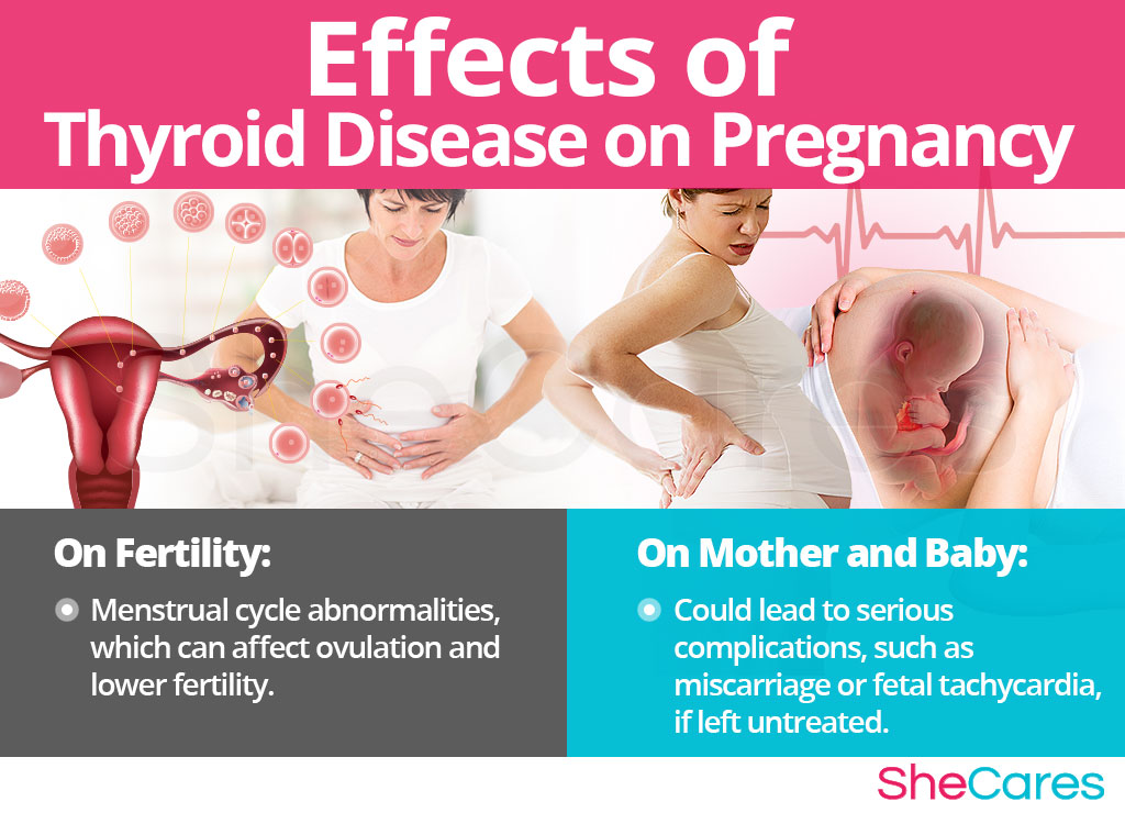 Possible Effects of Thyroid Disease on Conceiving and Pregnancy