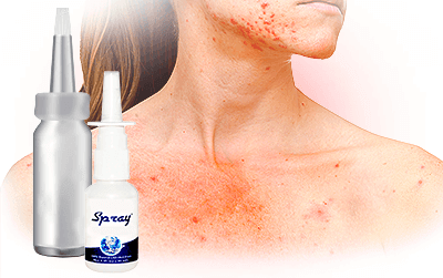 All about Mold Allergy